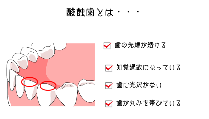 tooth-erosion1